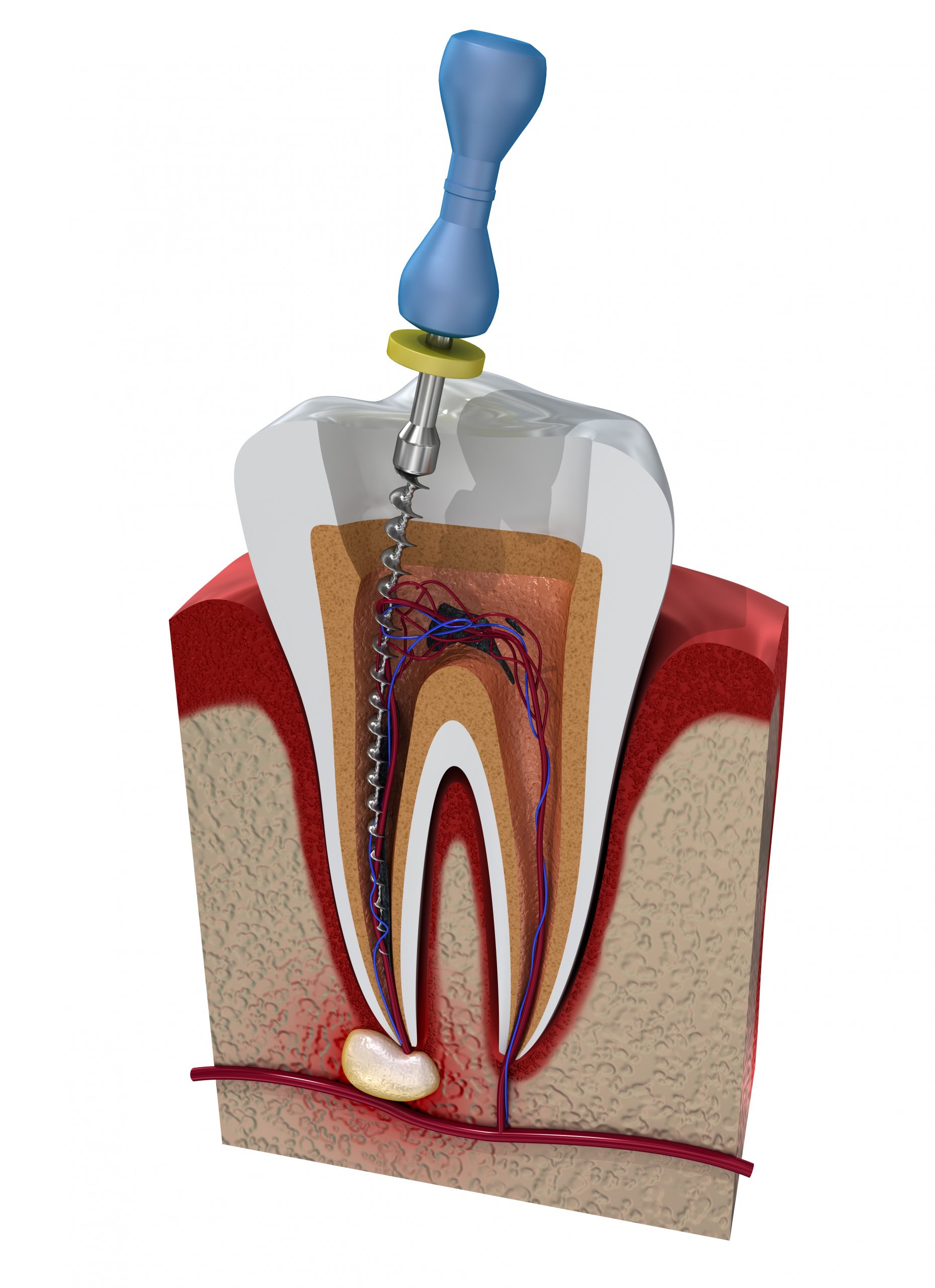 Root Canal