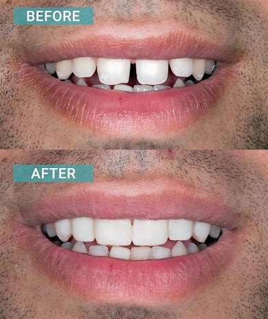 Porcelain Veneers